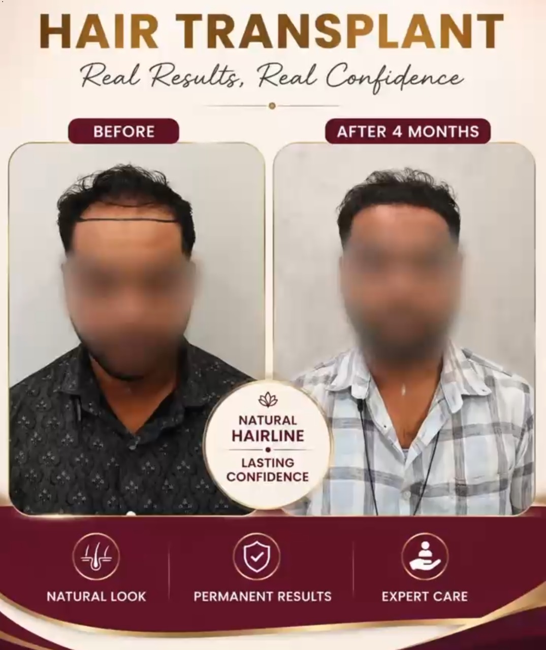 Best hair transplant clinic in chennai