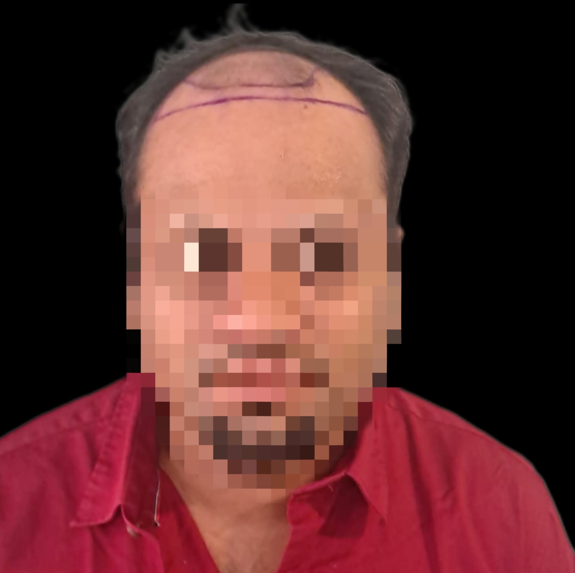 Bloom Hair Transplant Clinic