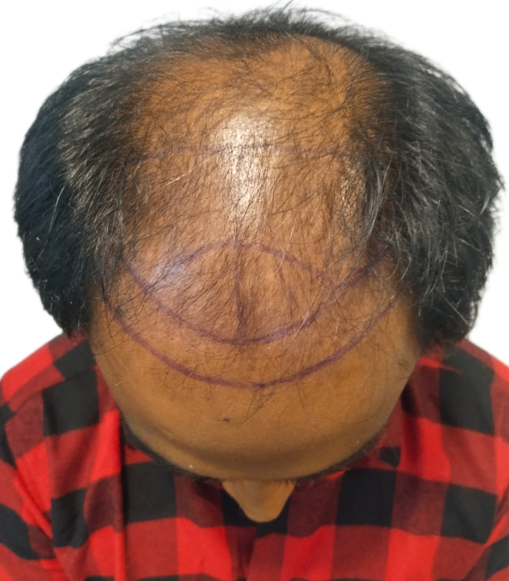 Bloom Hair Transplant Clinic