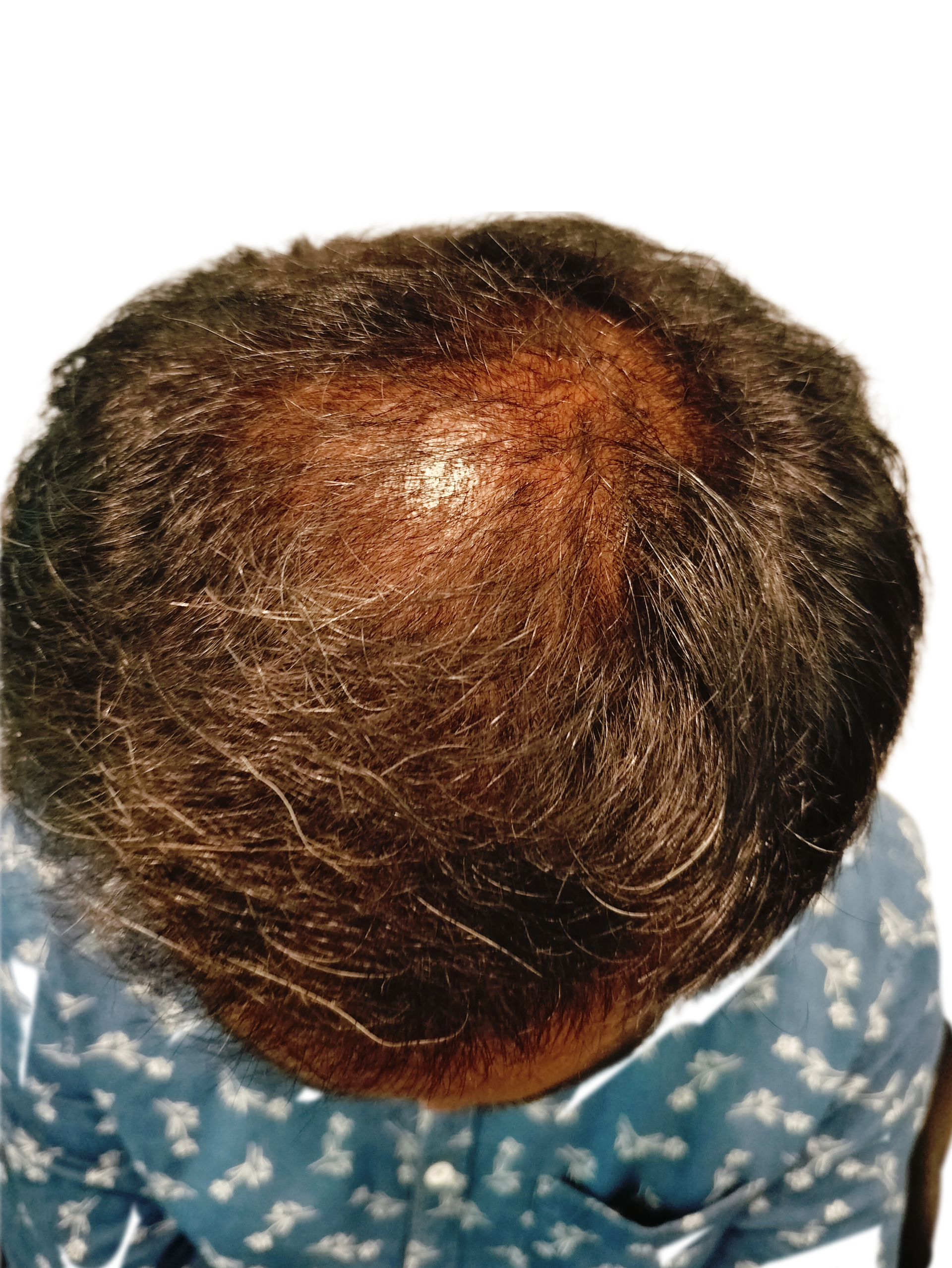 Bloom Hair Transplant Clinic