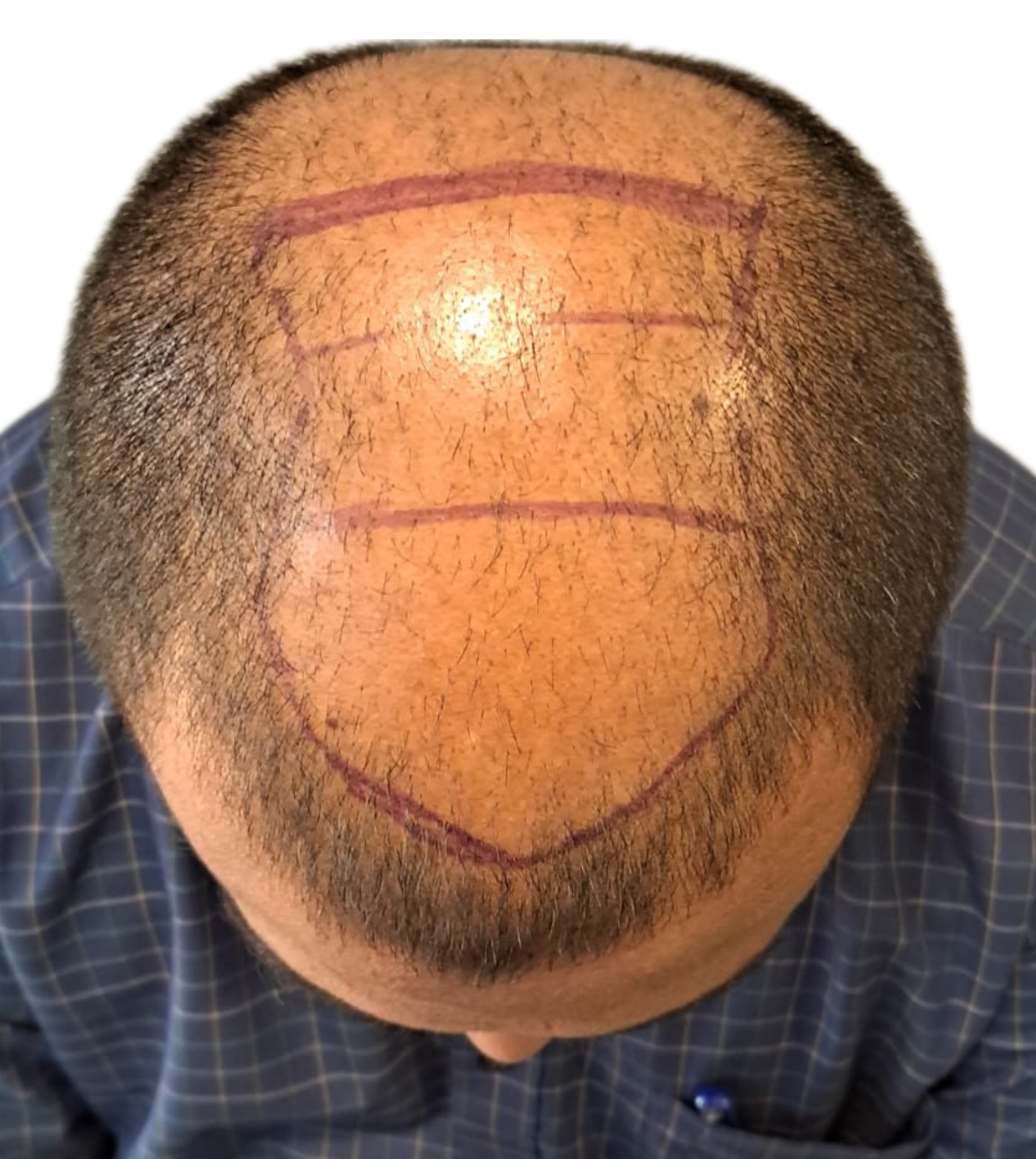 Bloom Hair Transplant Clinic