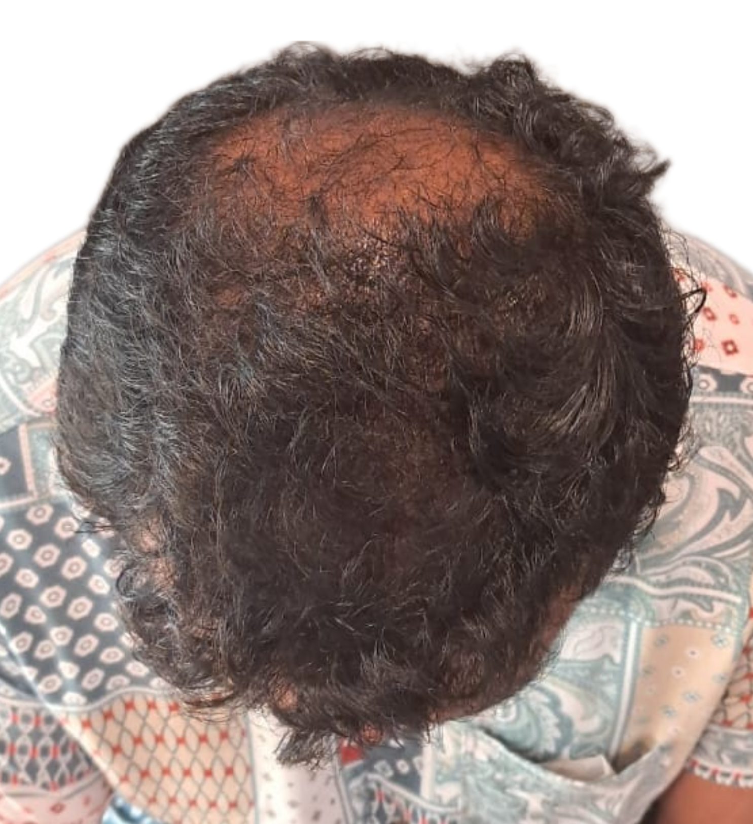 Bloom Hair Transplant Clinic